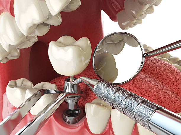 Best Emergency Tooth Extraction in Titusville, FL